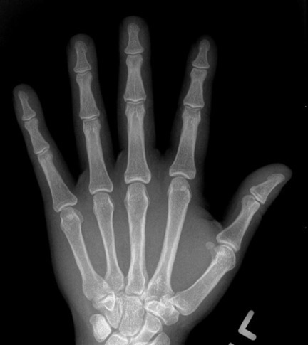 Handxray